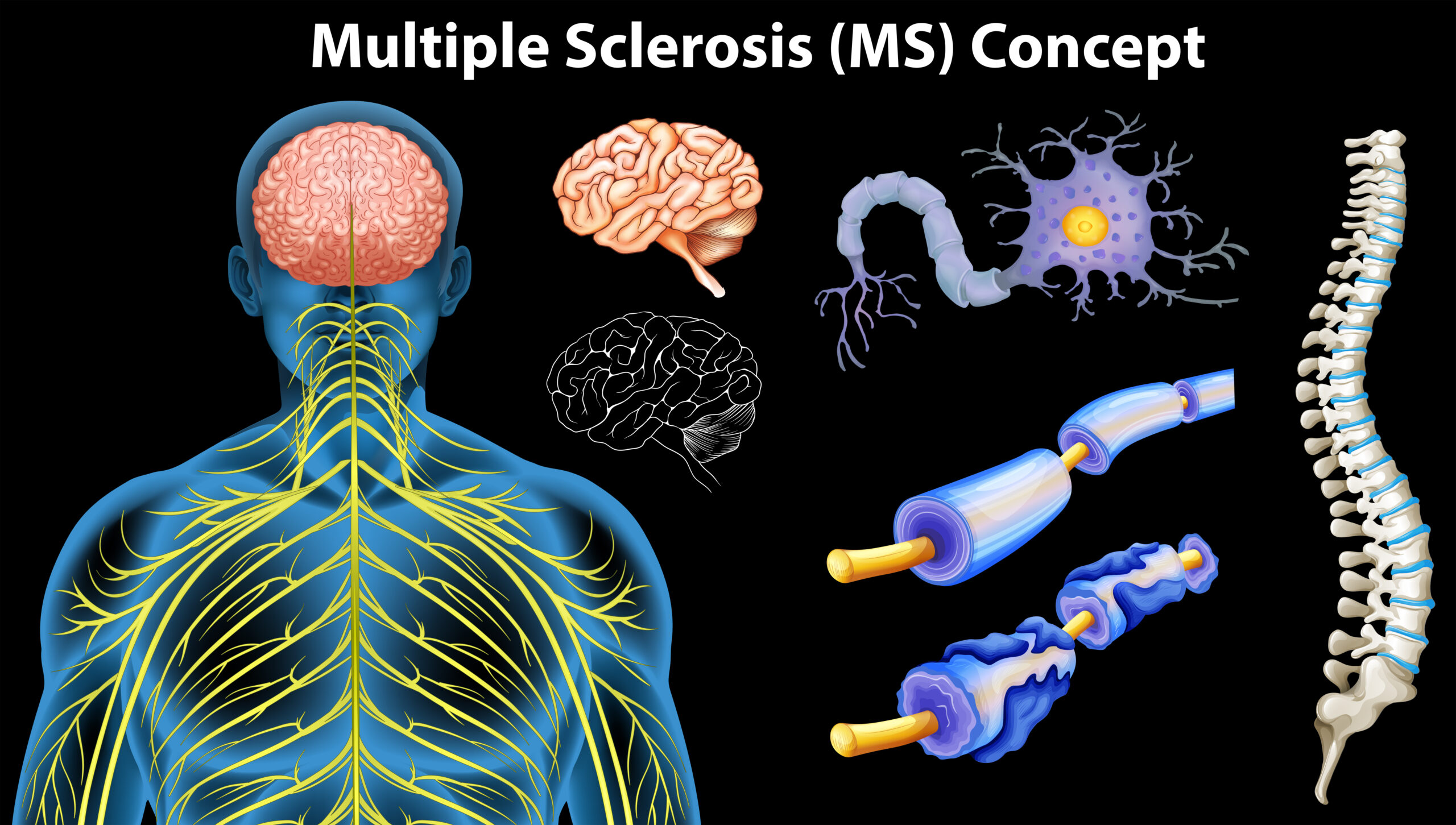 multiple sclerosis